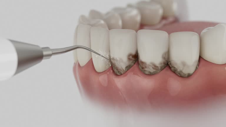 Trusted Invisalign Clear Aligners service in Minster, OH - Dentist Open Now